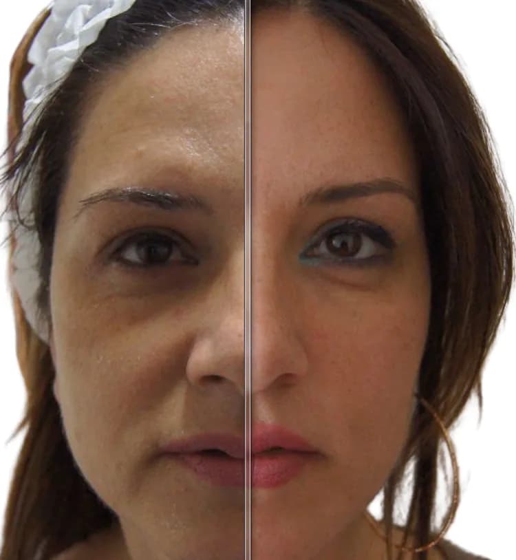 Split-image comparison of facial skin before and after AquaFirme XS treatment