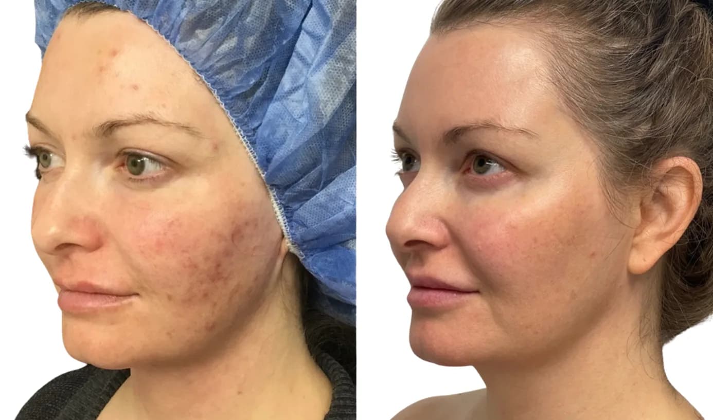 Before and after Scarlet SRF microneedling showing reduced acne and improved skin texture on the cheek and jawline